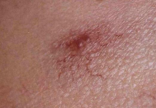 angioma คืออะไร?